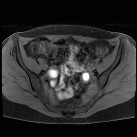can endometriosis be seen on ct scan